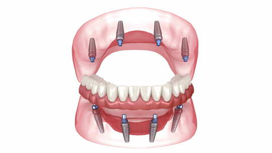 8个植入物支持的假体。牙科3D动画