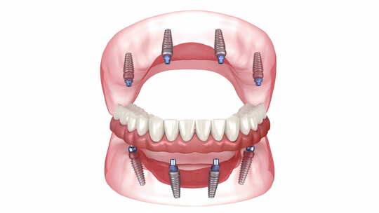 8个植入物支持的假体。牙科3D动画视频素材模板下载
