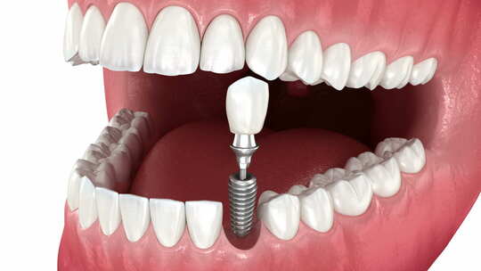 牙科植入物和陶瓷冠放置。医学上精确的牙齿