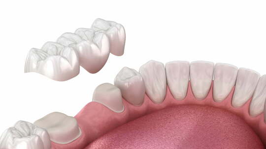 牙桥放置。3D动画