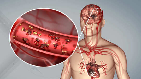 三维 人体血管 血栓 形成血栓 血管堵塞