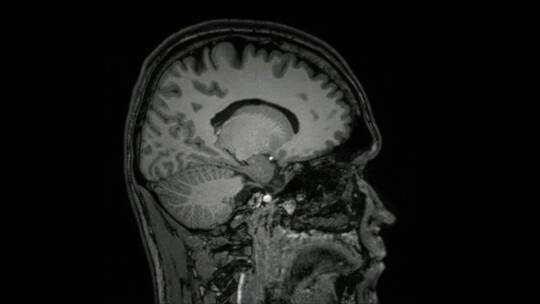 脑部ct扫描
