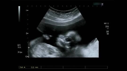 胎儿在母体子宫内的超声波视频素材模板下载