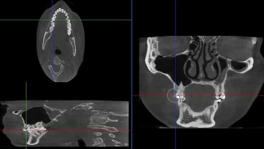 口腔CBCT 冠状位CT 头部CT 查看报告