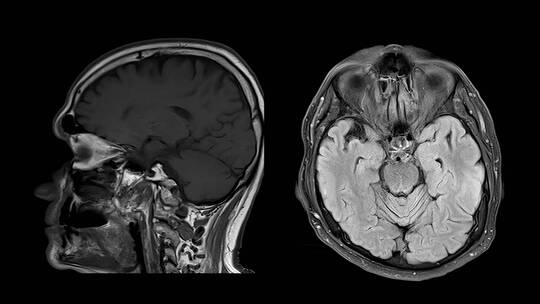 核磁共振脑部CT扫描MIR视频素材模板下载
