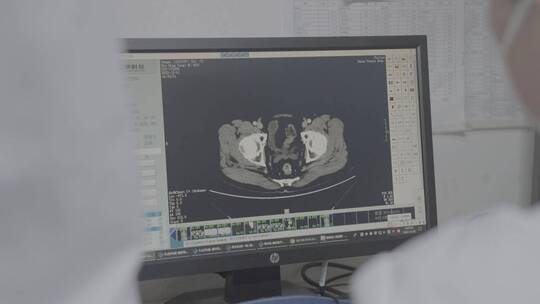 医生观察肺部ct