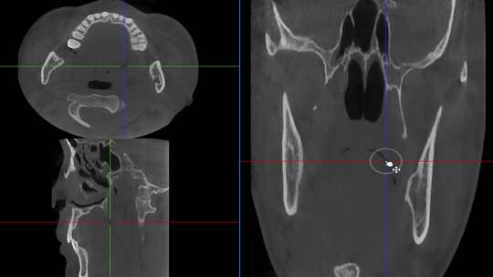 查看报告 口腔CBCT 轴位 牙齿CT 成像