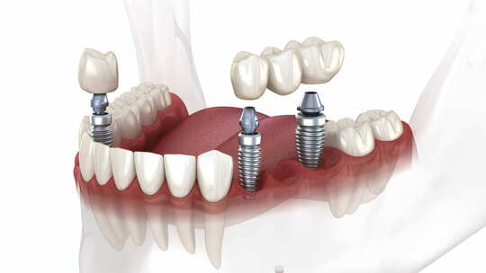 种植体上的牙桥和牙冠放置。牙科3D动画概