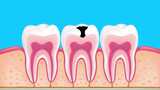 牙齿内部结构图，显示蛀牙侵蚀情况高清在线视频素材下载