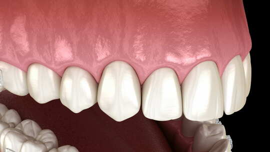 医学口腔牙科牙齿矫正修复3D模拟演示