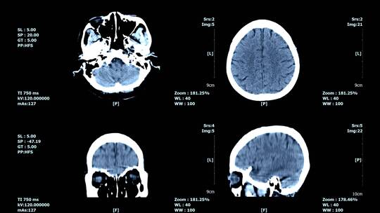 脑部CT影像视频素材模板下载