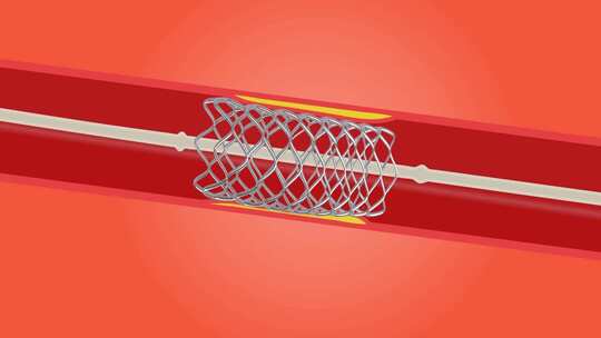心脏血管支架动画效果演示