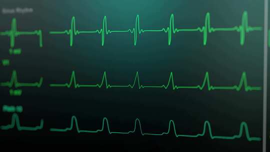 患者监护仪显示生命体征心电图心电图心电图