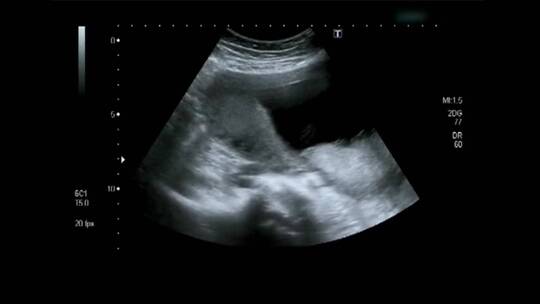 婴儿在母亲子宫内的超声波视频素材模板下载