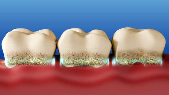 健康牙齿去除牙结石和牙垢清洁口腔卫生3D