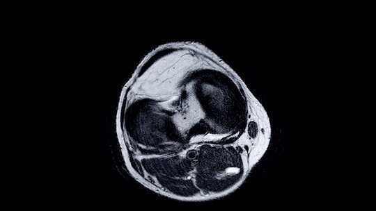 右膝关节磁共振成像（MRI）