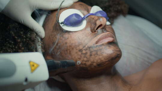 激光设备美容师治疗皮肤的特写面部剥离程序