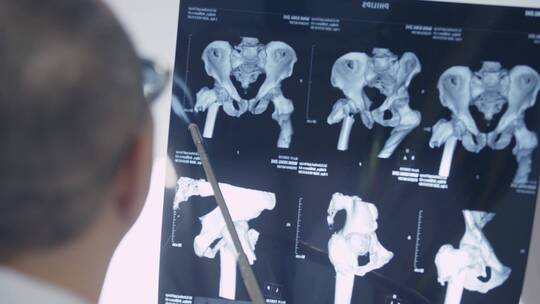 骨科专家 骨伤科 x光片 中医骨科视频素材模板下载