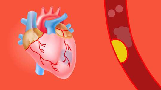 冠心病动画演示视频素材模板下载