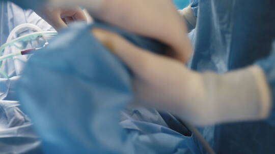 孕妇在医院进行剖腹产手术实拍素材