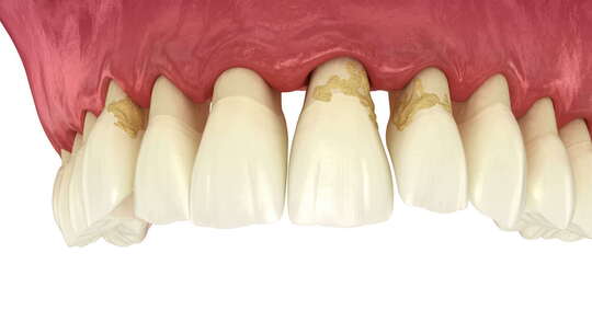 牙周炎和牙龈衰退的动力学，牙齿脱落。牙科视频素材模板下载