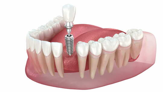 种植牙安装和牙冠放置。3d动画视频素材模板下载