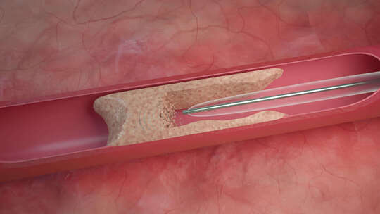 超声波血栓血管钙化血栓去除冠状动脉钙化
