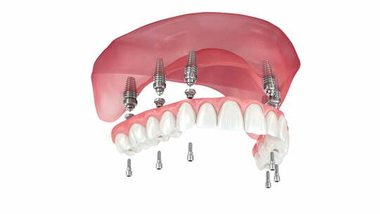 由六个植入物支撑的假体。3D动画