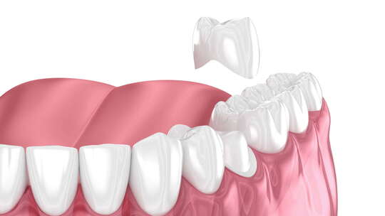 准备好的前磨牙和牙冠放置。牙科3D动画