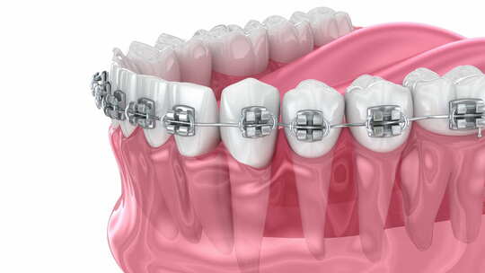 医学牙科牙齿矫正修复3D模拟演示