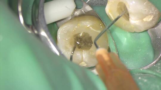 口腔中心牙科牙医显微镜视频修牙补牙实拍