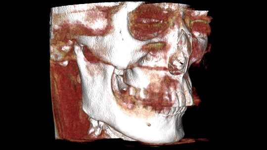 口腔CBCT 轴位 头像3D 牙齿三维