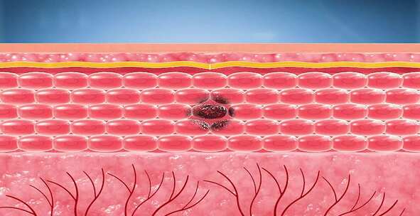 皮肤愈合表皮 皮肤 粘膜溃疡 细胞再生