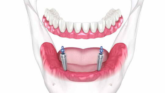 医学牙科牙齿矫正修复3D模拟演示