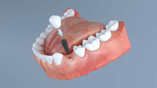 种牙 种植牙 牙齿矫正 牙齿健康 修牙视频素材模板下载