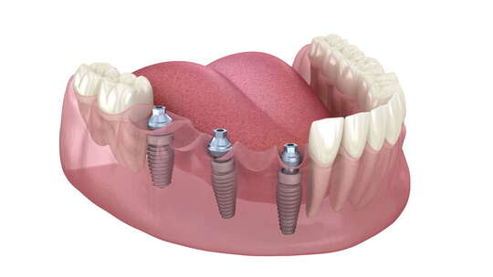 基于 3 个种植体的牙桥