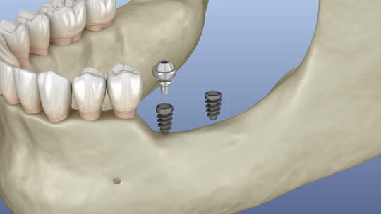 微型植入物植入下颌骨：医学上精确的3D动