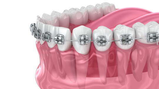 用牙套矫正丘比特。医学上准确的牙科3D动视频素材模板下载