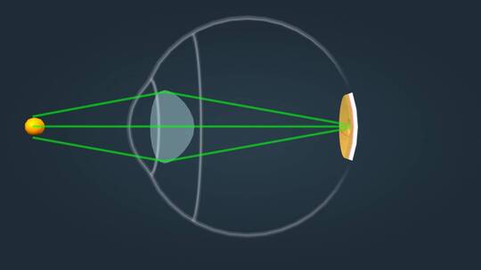 近视眼远视眼视力矫正医学三维动画
