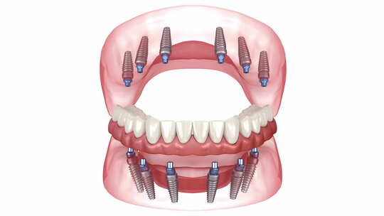 由6个植入物支持的假体。牙科3D动画