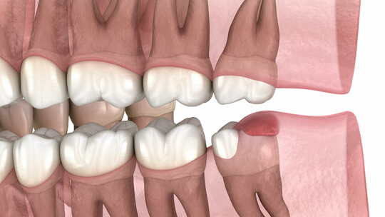 智齿和牙龈炎症。医学上准确的牙齿3D动画