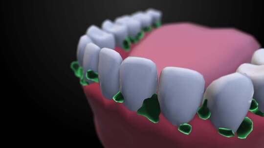 牙齿上的菌斑