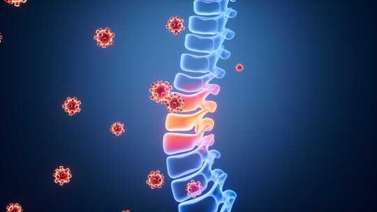 人类脊椎脊柱发炎感染和病毒动画
