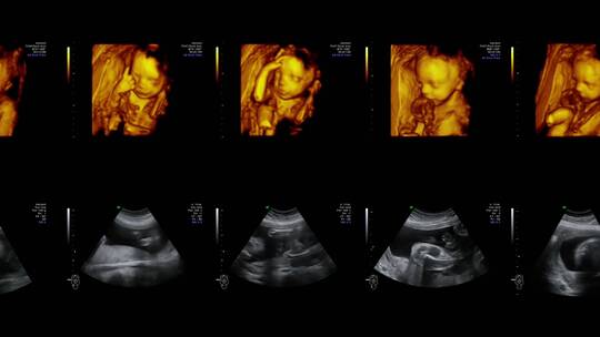 婴儿在母体里的B超影像