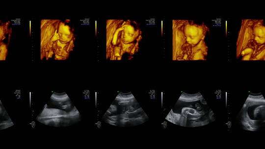 婴儿在母体里的B超影像视频素材模板下载