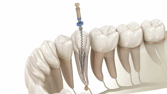 牙髓根管治疗过程视频素材模板下载