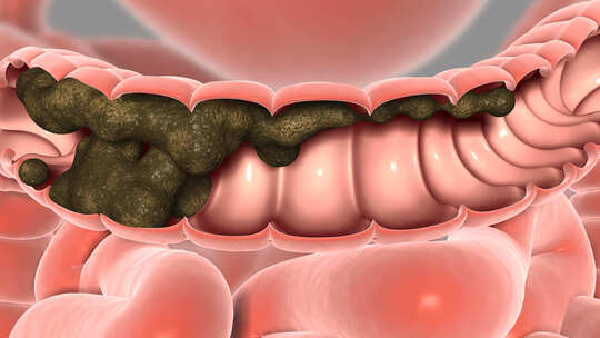 宿便堆积 宿便口臭 肠胃功能紊乱 肠道疾病
