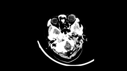 动态头部CT影像 头骨CT影像视频素材模板下载