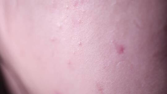 皮肤问题痤疮长痘痘印