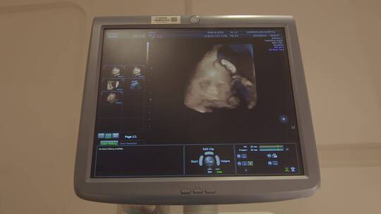 怀孕B超 超声波 孕妇 怀孕 婴儿视频素材模板下载